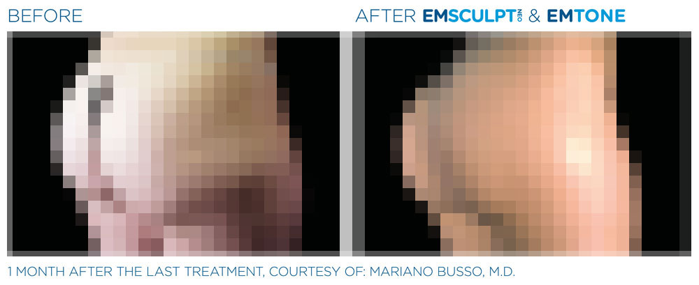 Emsculpt Neo - Before  and After