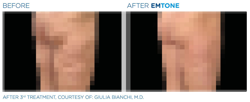 Emtone - Before  and After