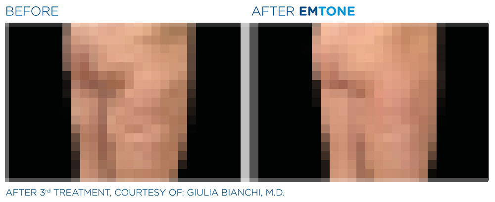 Emtone - Before and After Emtone - Before and After