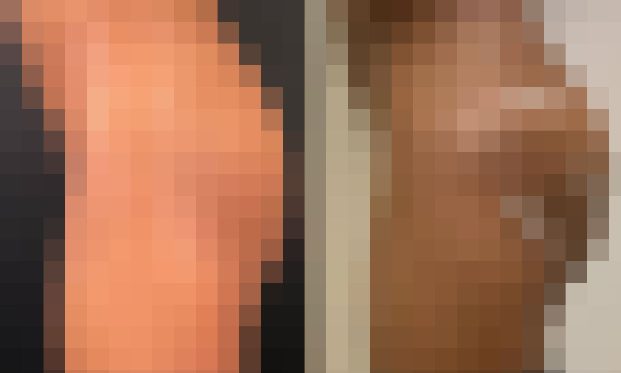 Radiesse - Before and After Radiesse - Before and After