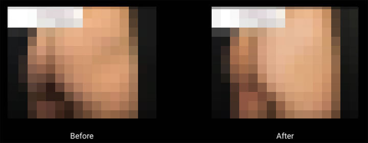 Sculptra - Before and After Sculptra - Before and After
