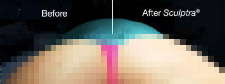 Sculptra - Before and After Sculptra - Before and After