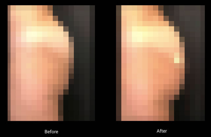 Sculptra - Before and After Sculptra - Before and After