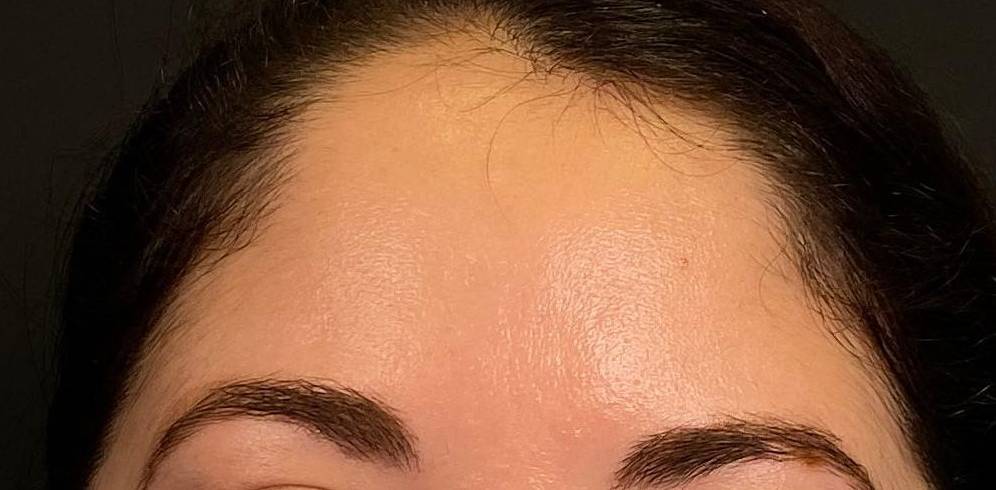 Acne Before and After Case 15 After