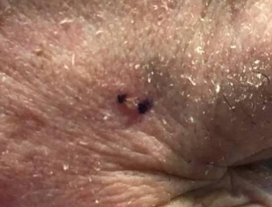 Skin Cancer Before and After Case 24 Before