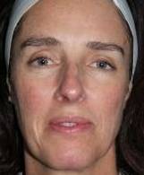 IPL-Photofacial/BBL Before and After Case 2 Before
