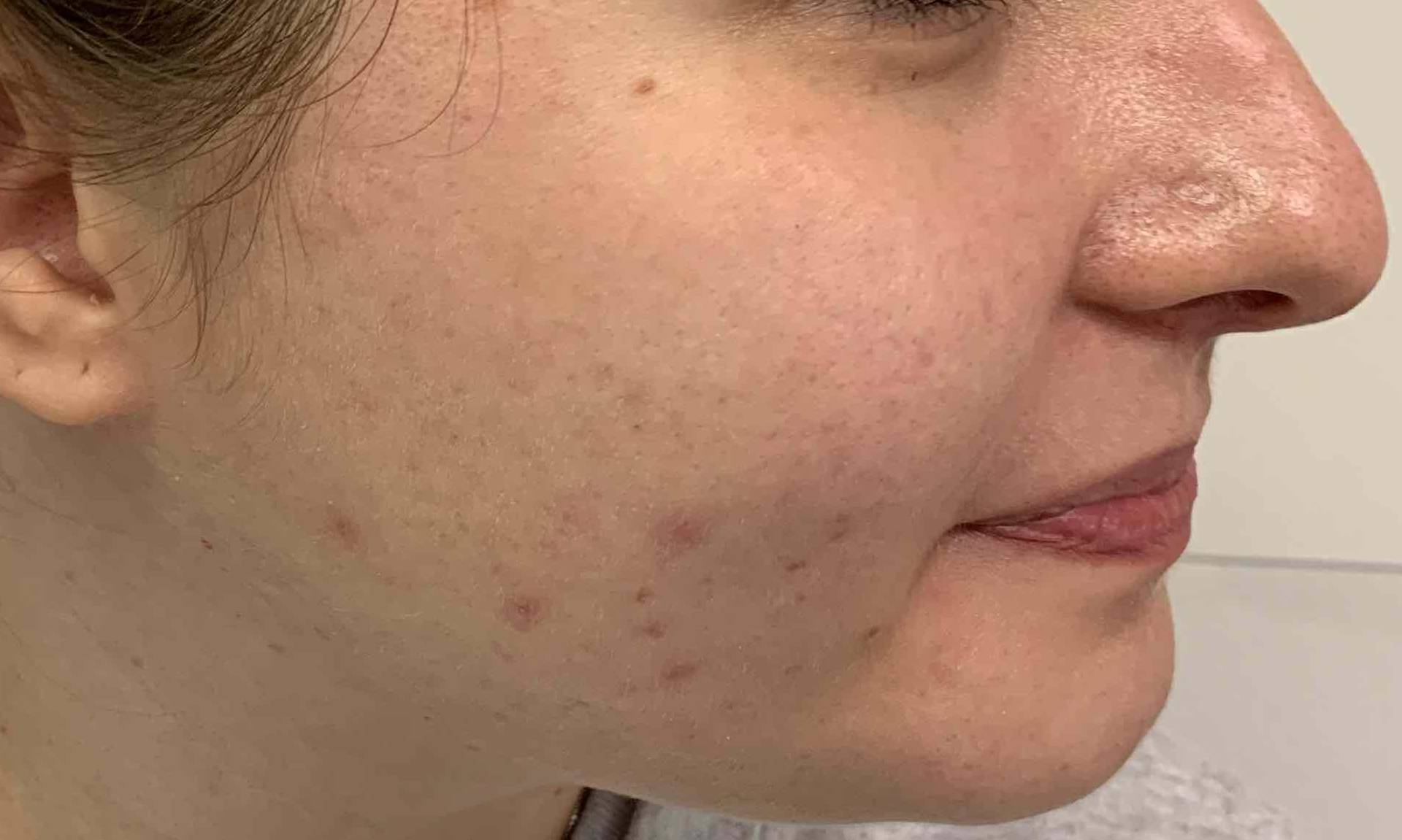 Acne Before and After Case 16 Before