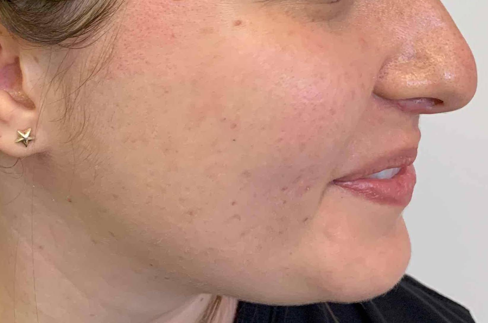 Acne Before and After Case 16 After
