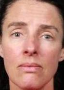 IPL-Photofacial/BBL Before and After Case 2 After