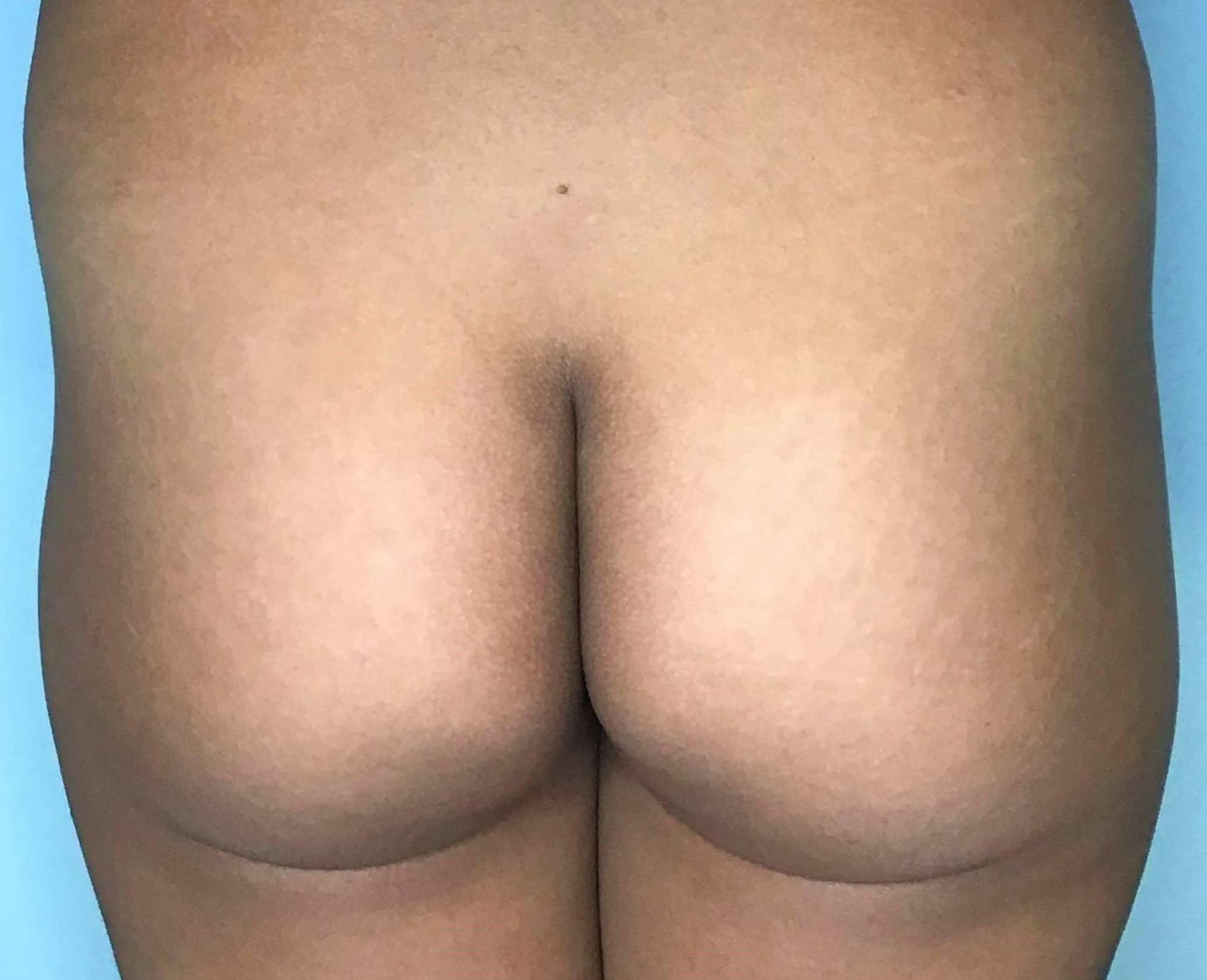 Radiesse (40+ Syringes) Case-9 Before