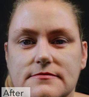 IPL-Photofacial/BBL Before and After Case 3 After