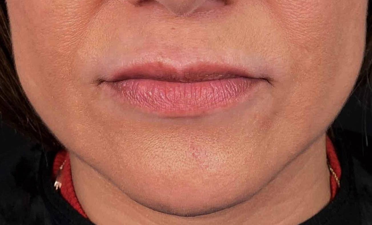 Juvederm (1 Syringe) Case 16 Before