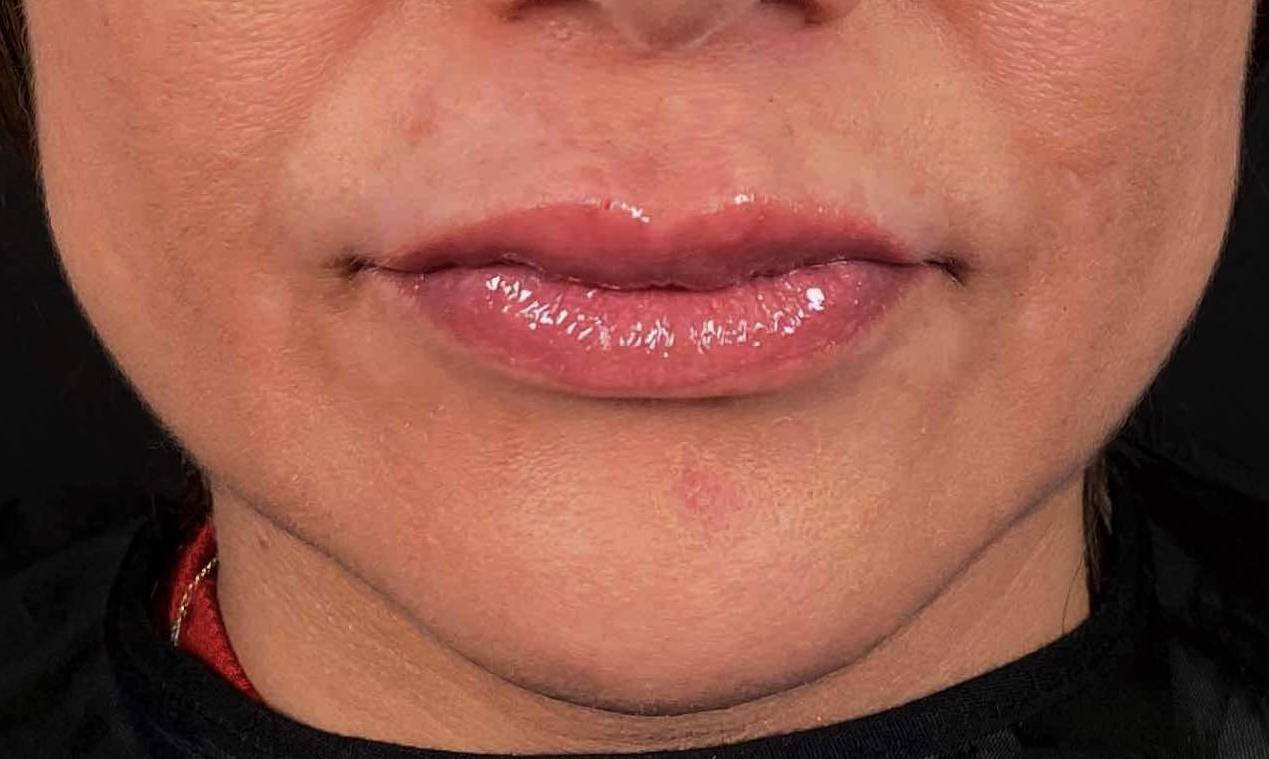 Juvederm (1 Syringe) Case 16 After