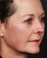 IPL-Photofacial/BBL Before and After Case 5 Before