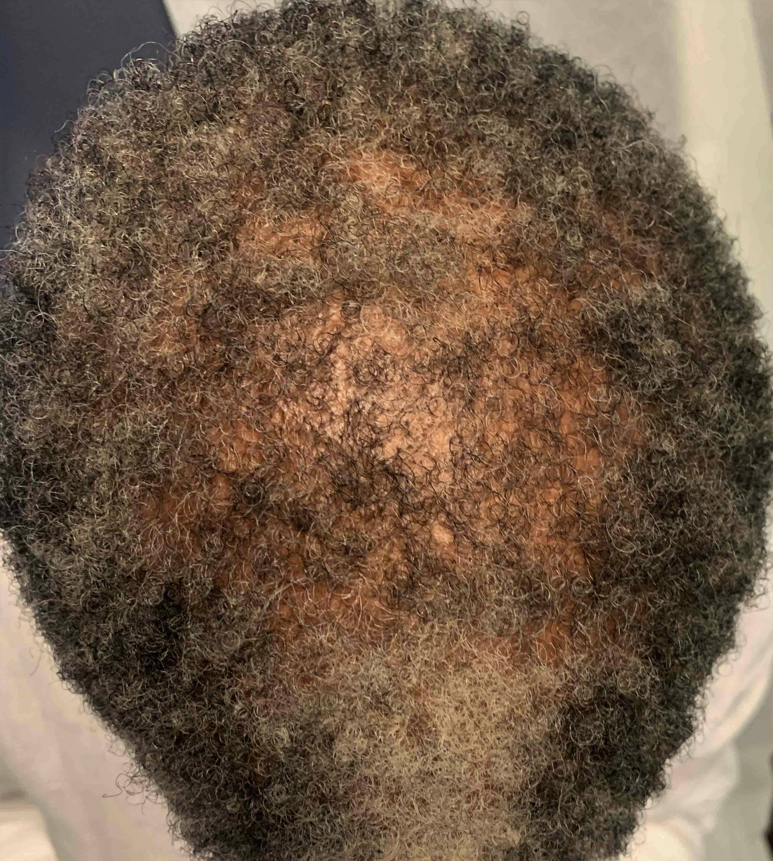 Exoflo Hair Restoration Before and After Case 5 Before