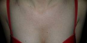 IPL-Photofacial/BBL Before and After Case 6 Before