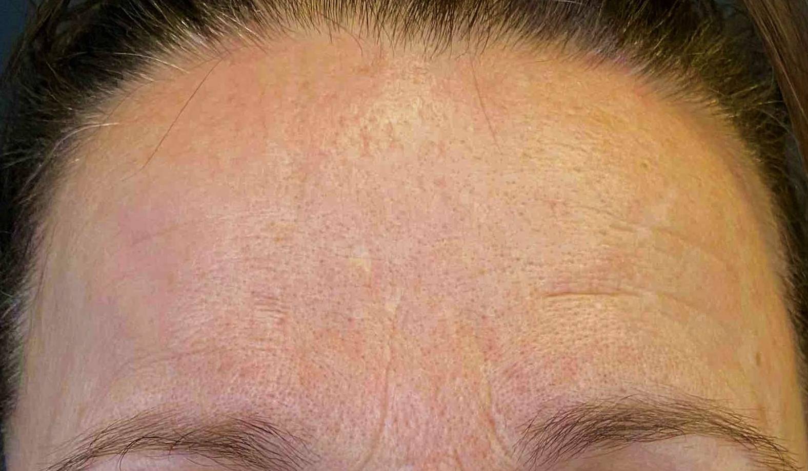 Exosomes (1 Treatment) 1 After