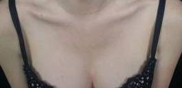IPL-Photofacial/BBL Before and After Case 6 After