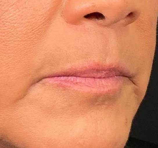 Juvederm (2 Syringes) Case 17 Before