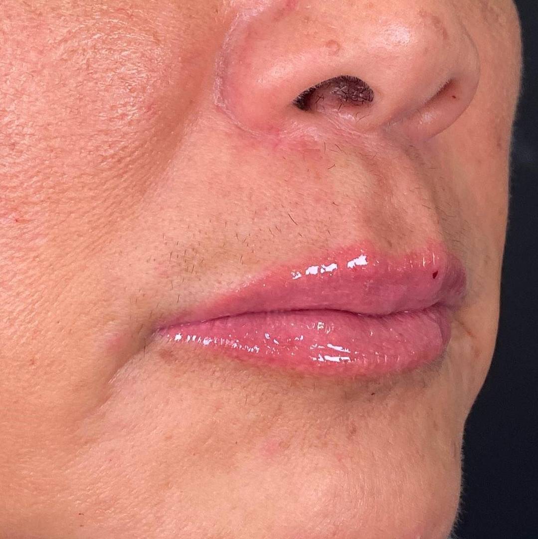 Juvederm (2 Syringes) Case 17 After