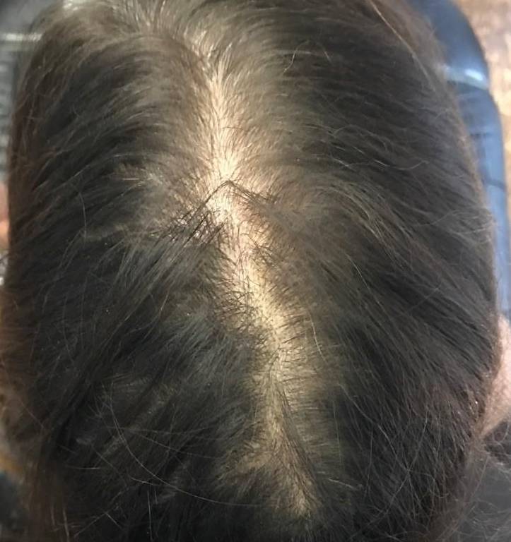 Exoflo Hair Restoration Before and After Case 7 Before