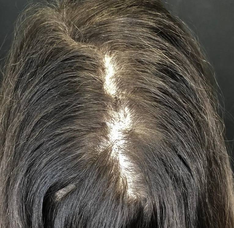 Exoflo Hair Restoration Before and After Case 7 After