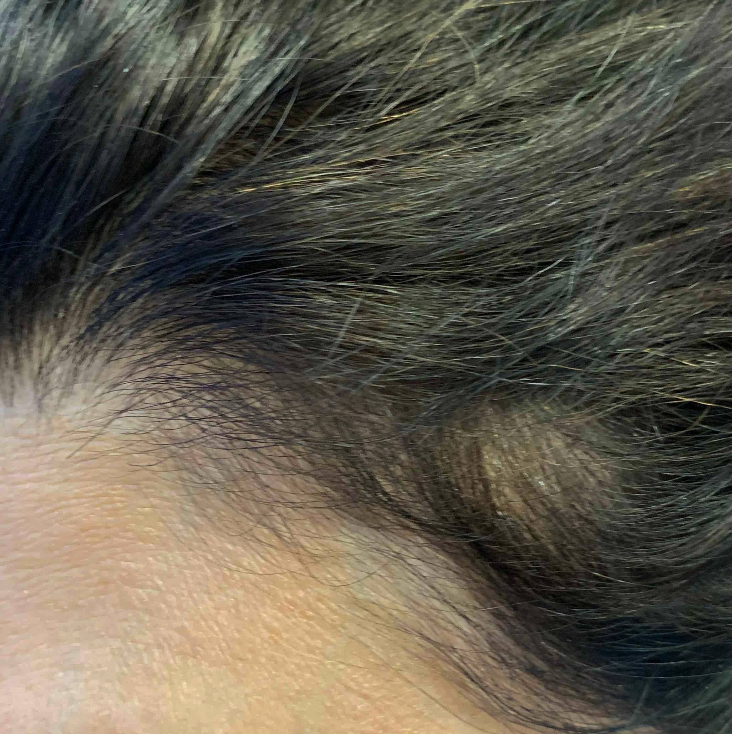 Exoflo Hair Restoration Before and After Case 8 After