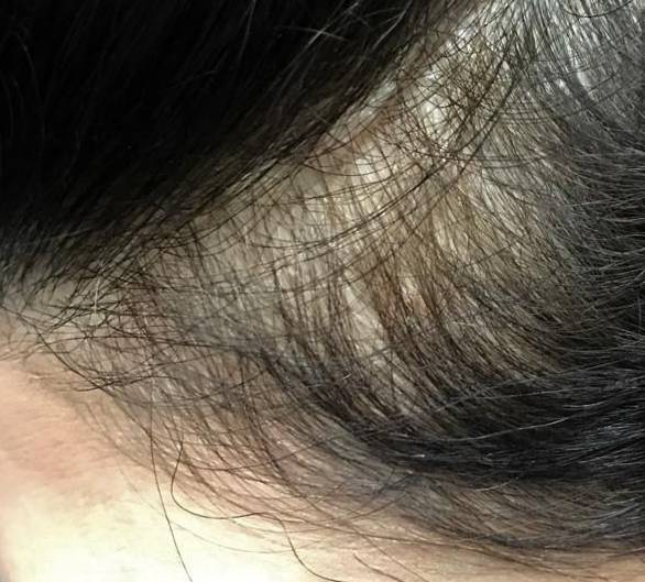 Hair Restoration Before and After Case 6 Before