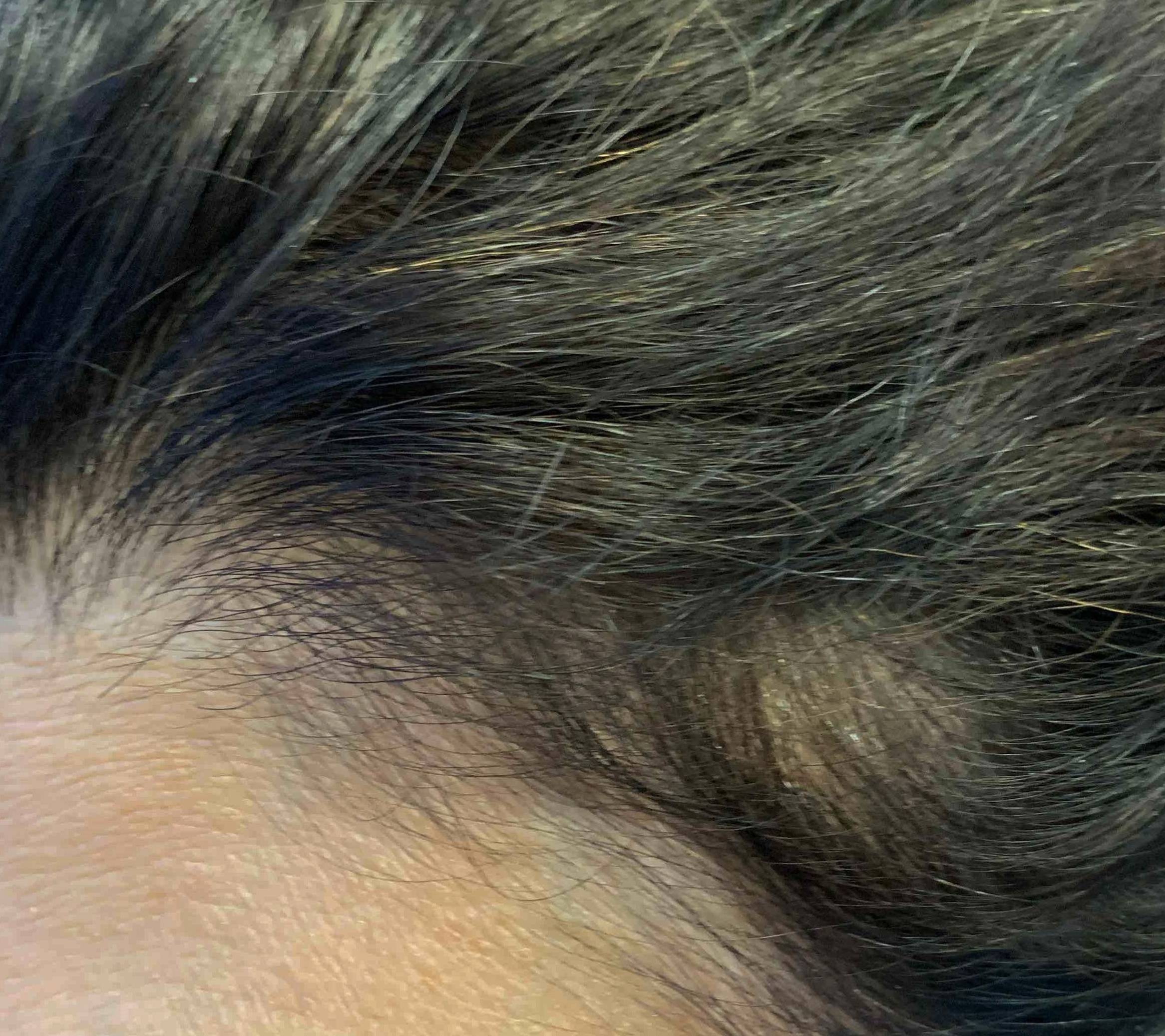 Hair Restoration Before and After Case 6 After