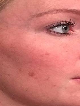 IPL-Photofacial/BBL Before and After Case 7 Before
