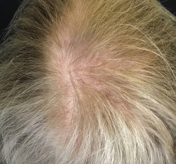 Hair Restoration Before and After Case 7 Before