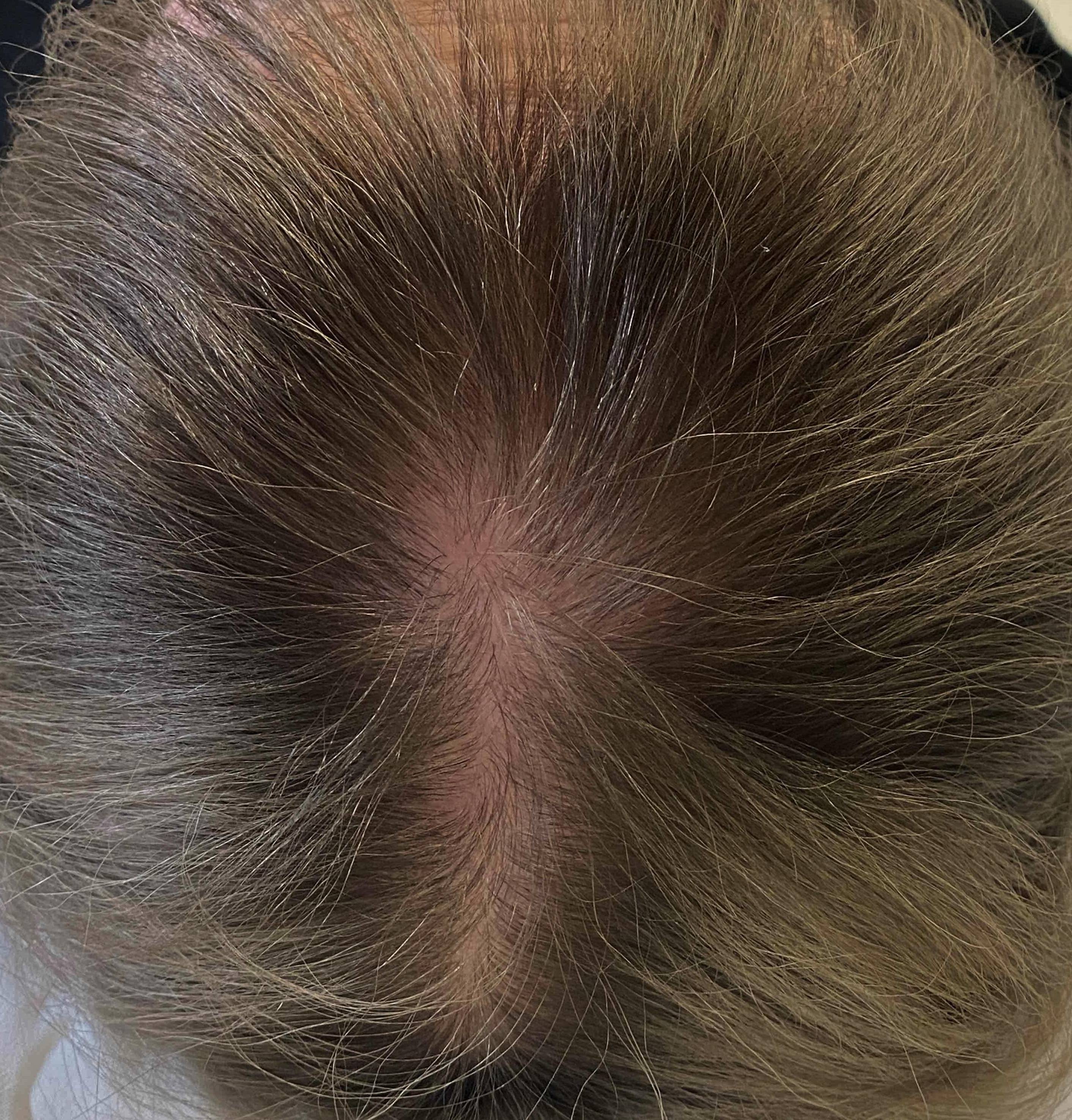 Hair Restoration Before and After Case 7 After