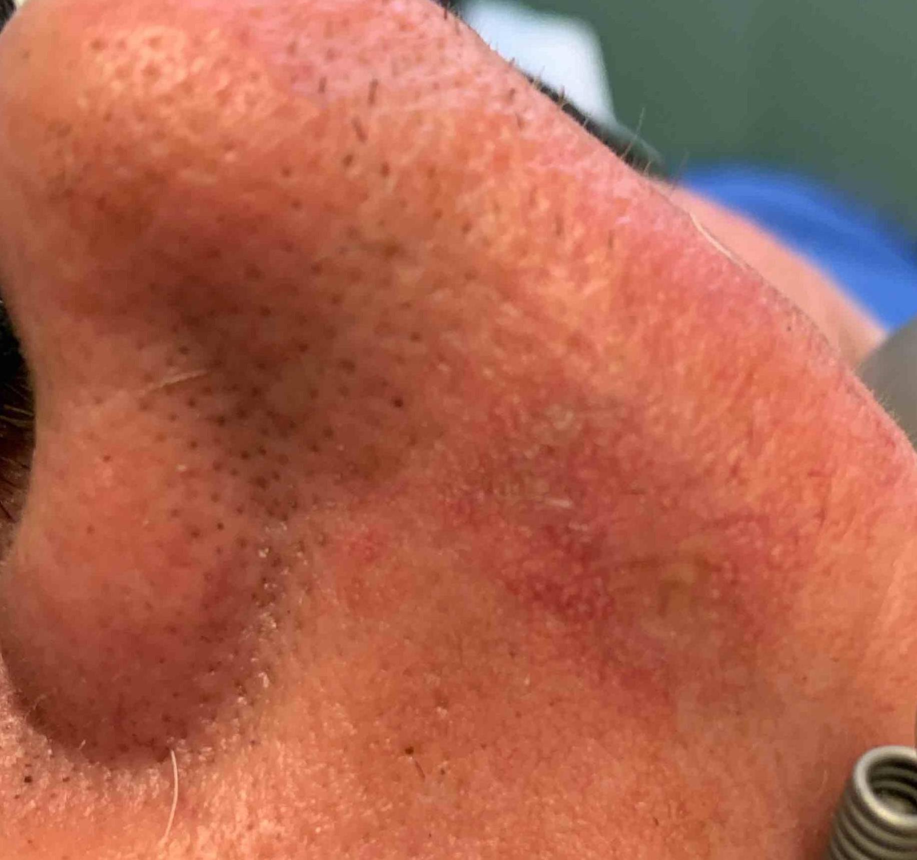 Skin Cancer Before and After Case 25 After