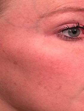 IPL-Photofacial/BBL Before and After Case 7 After