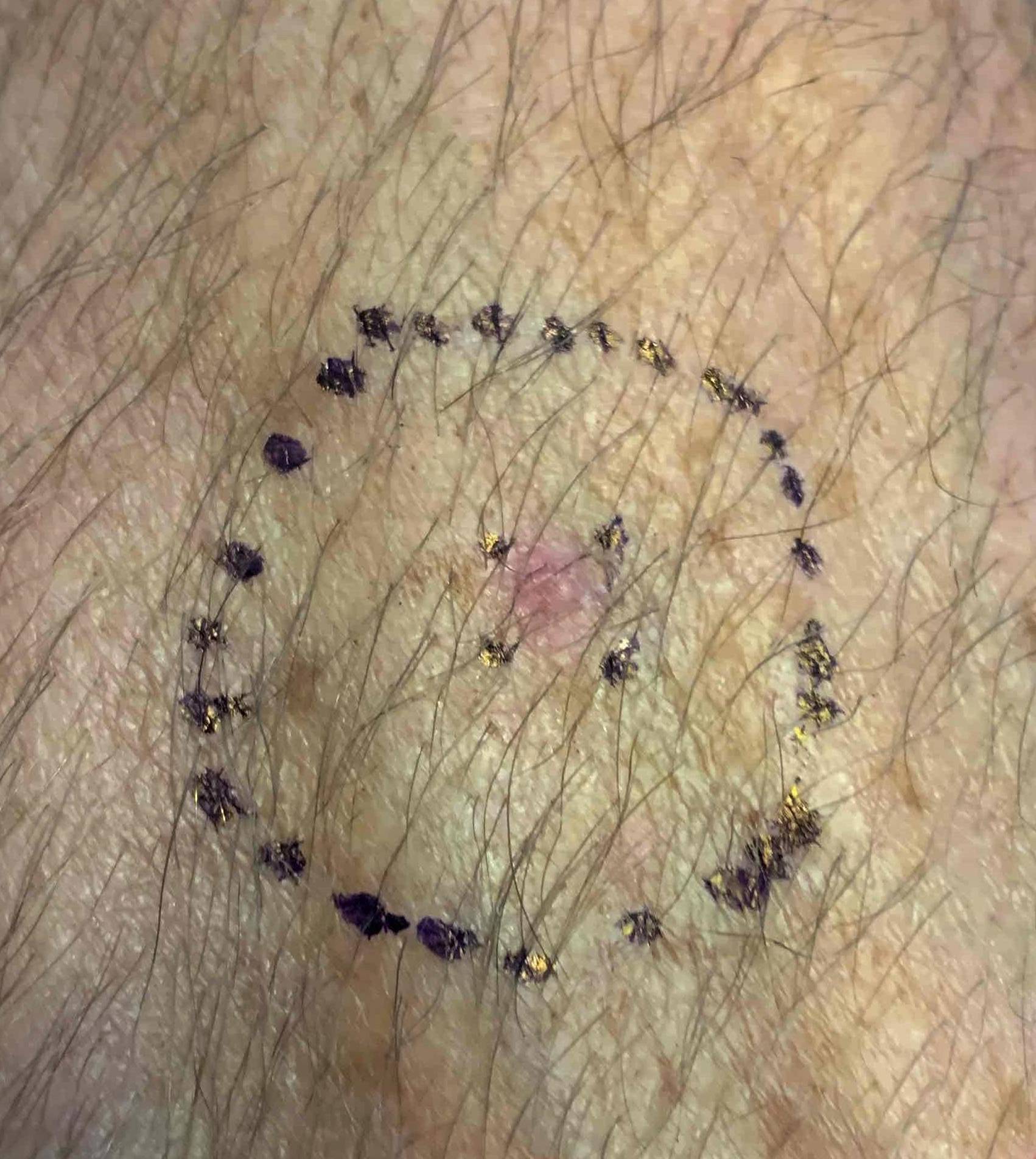 Skin Cancer Before and After Case 27 Before