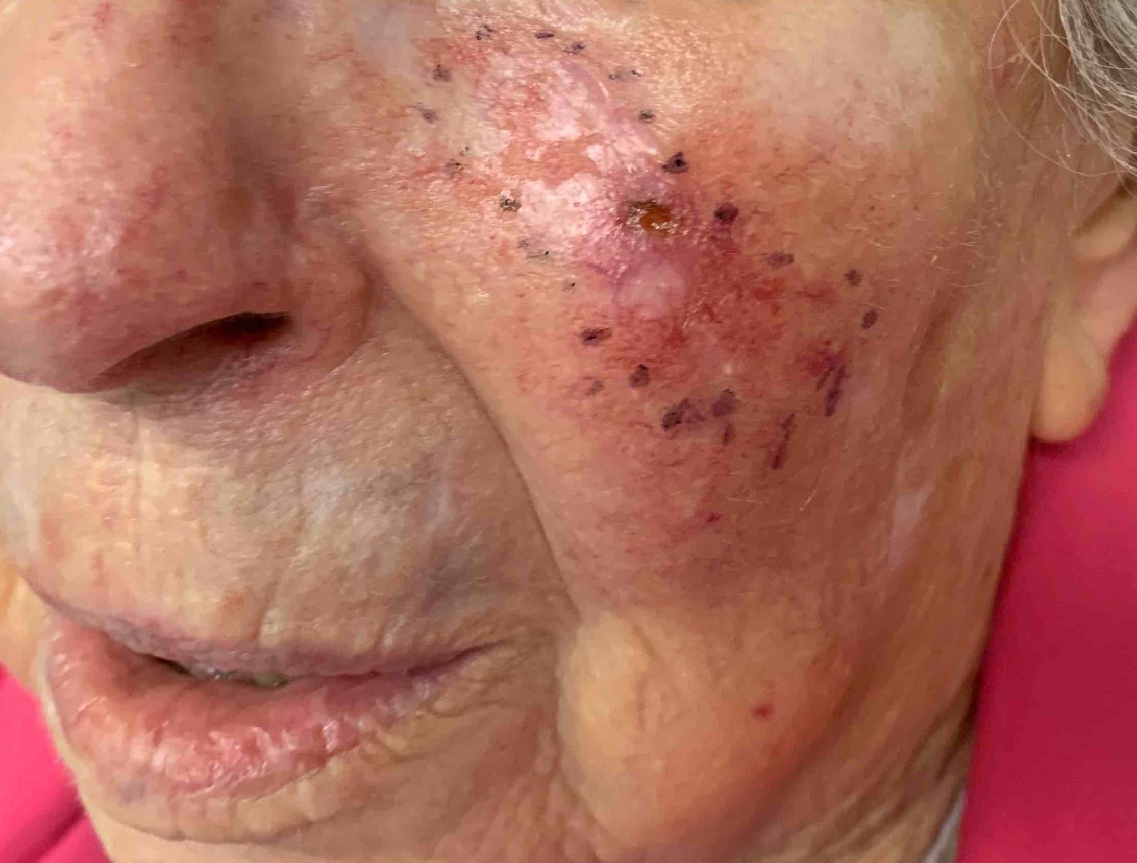 Skin Cancer Before and After Case 28 Before