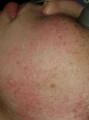 IPL-Photofacial/BBL Before and After Case 8 Before