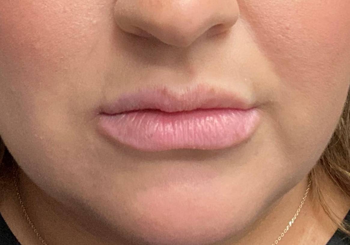Juvederm (1 Syringe) Case-18 Before