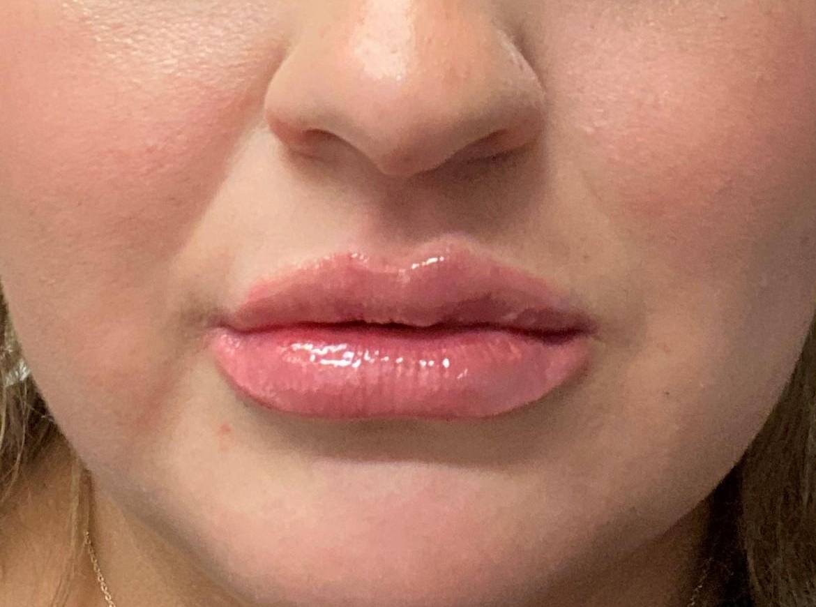 Juvederm (1 Syringe) Case-18 After