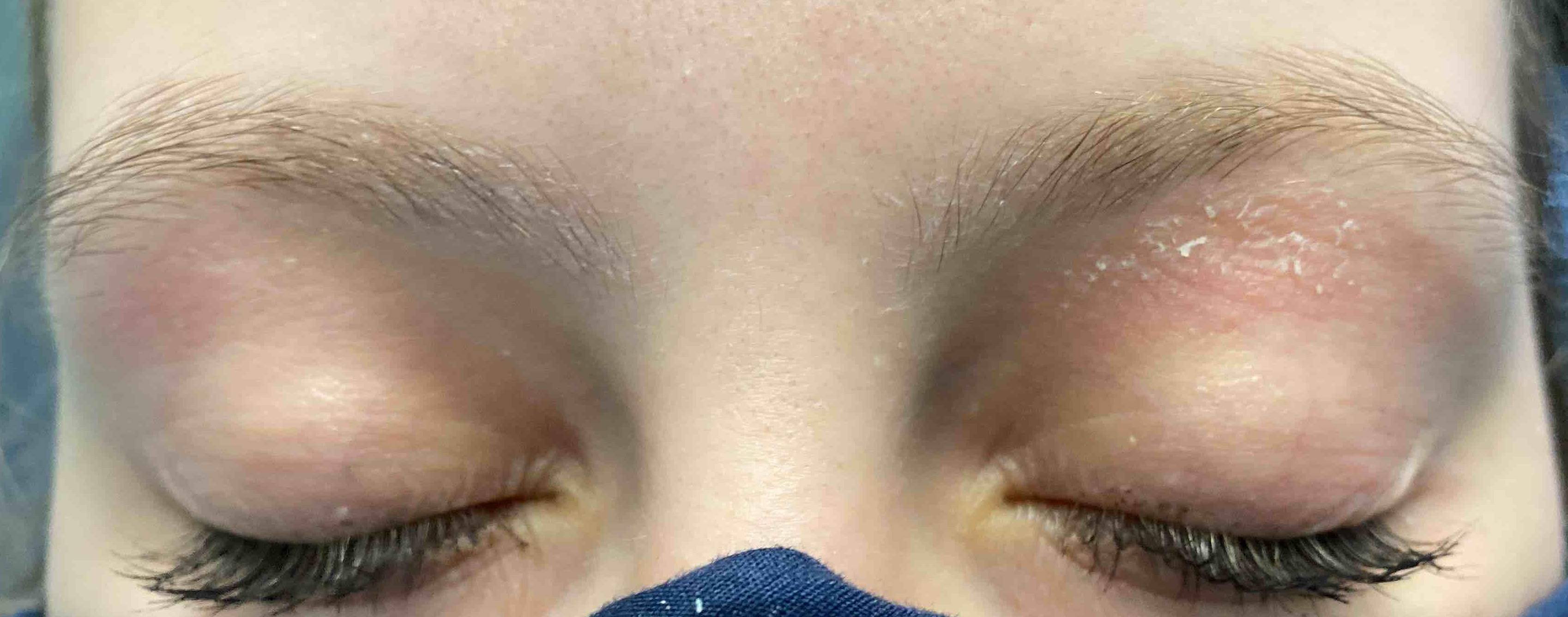 Eczema Before and After Case 17 Before