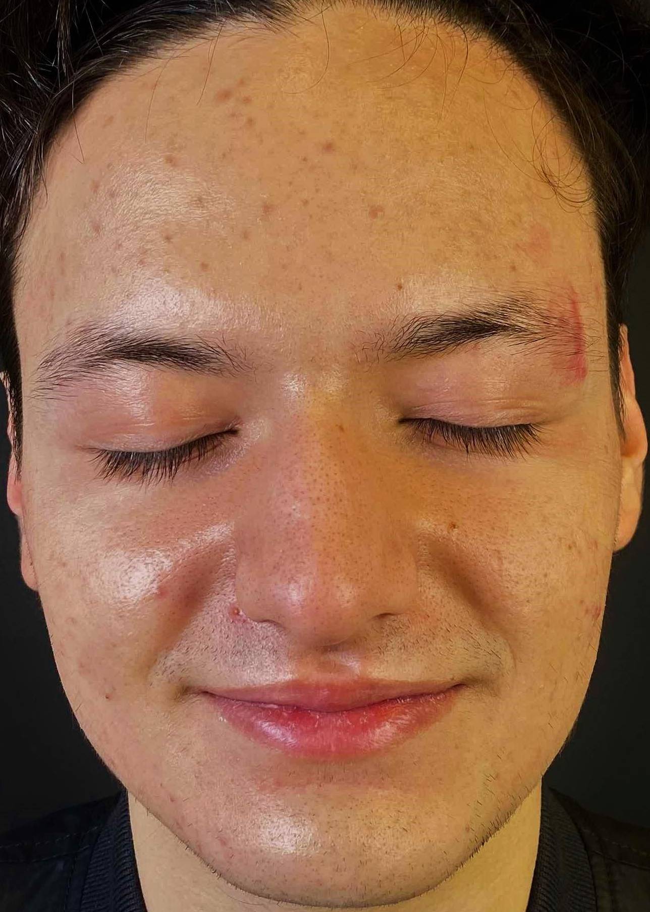 Acne Before and After Case 17 Before