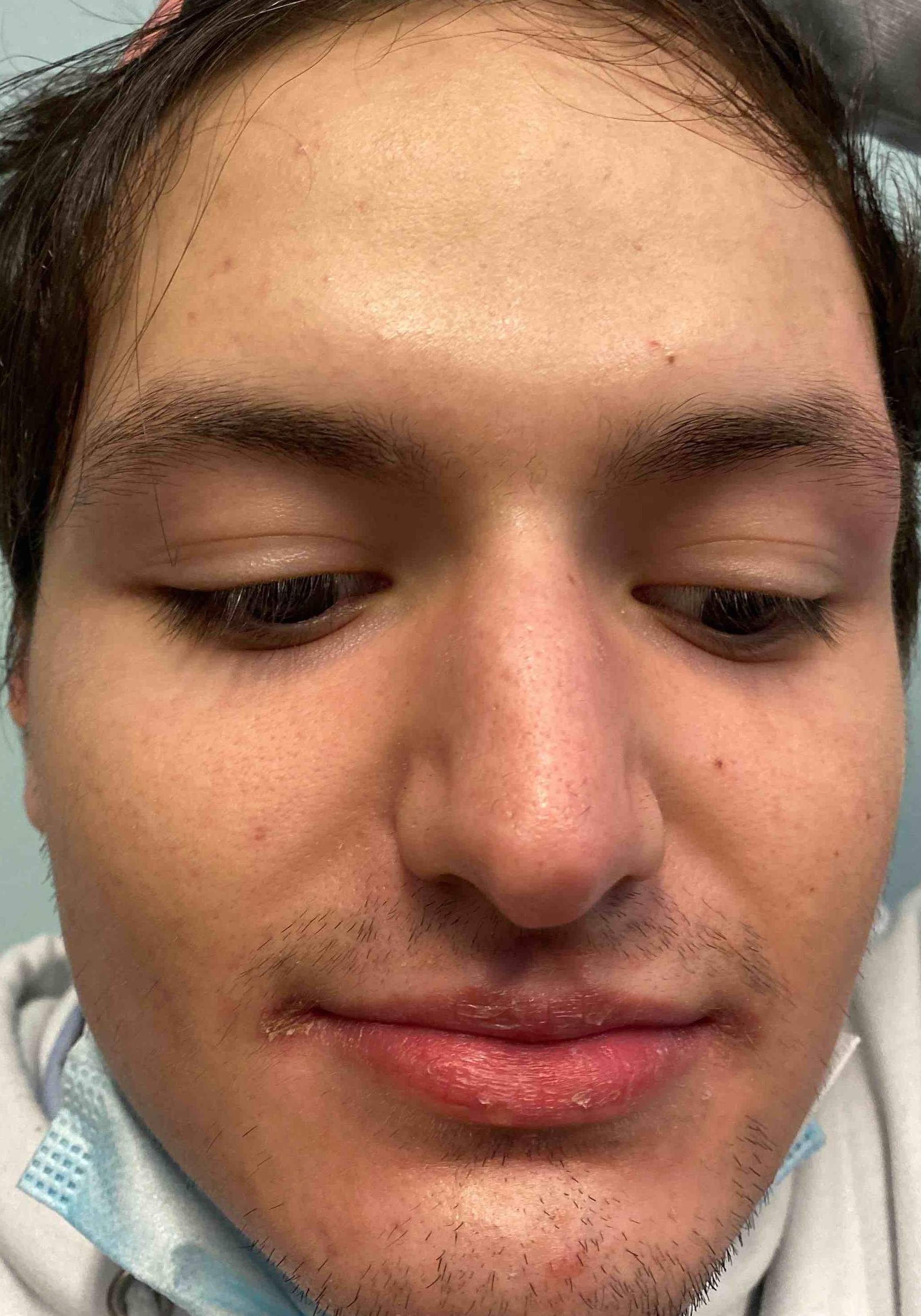 Acne Before and After Case 17 After