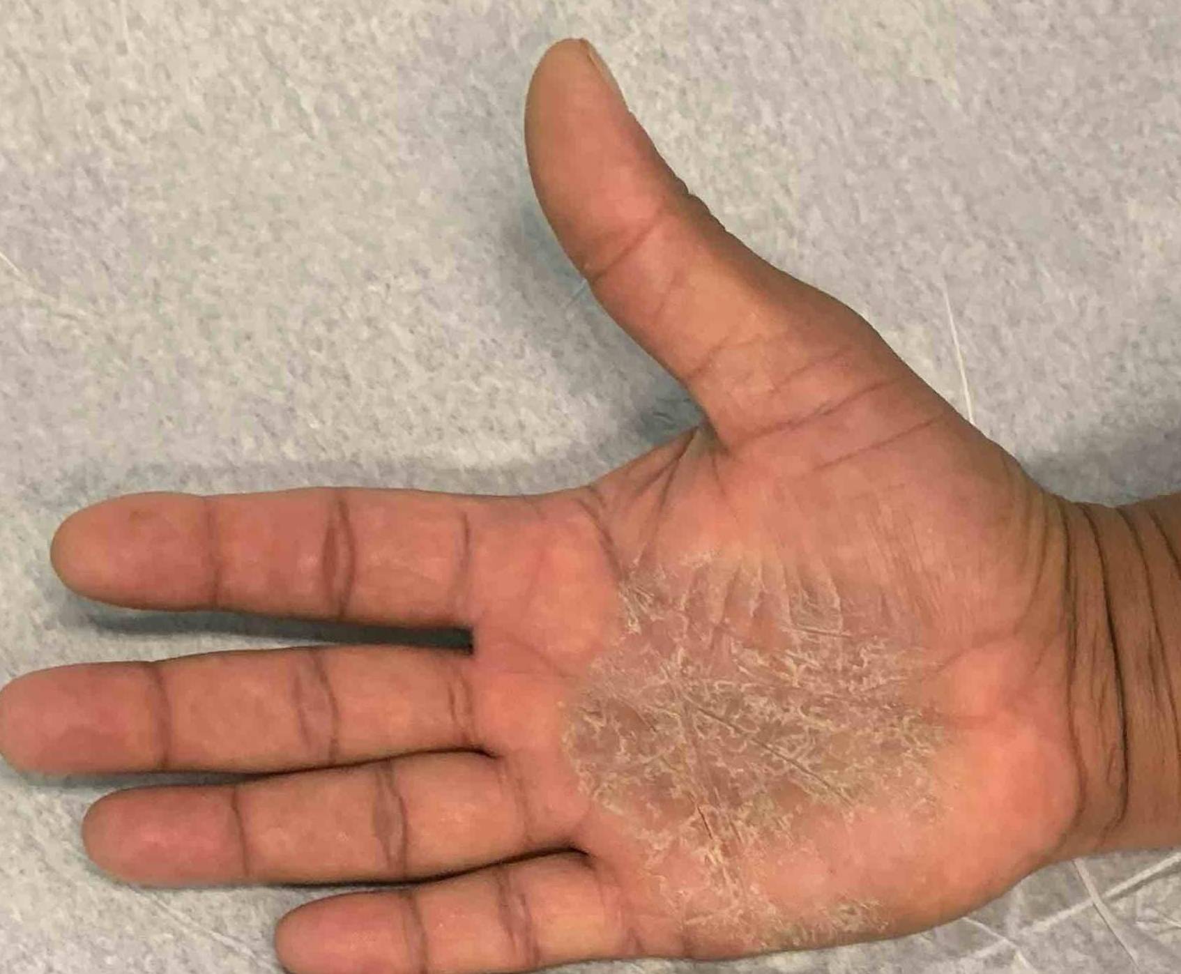 Psoriasis Before and After Case 31 Before
