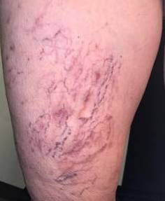 Vascular Treatment Before and After Case 1 Before