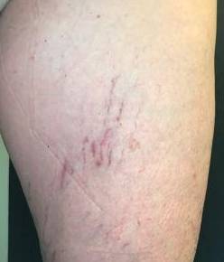 Vascular Treatment Before and After Case 1 After