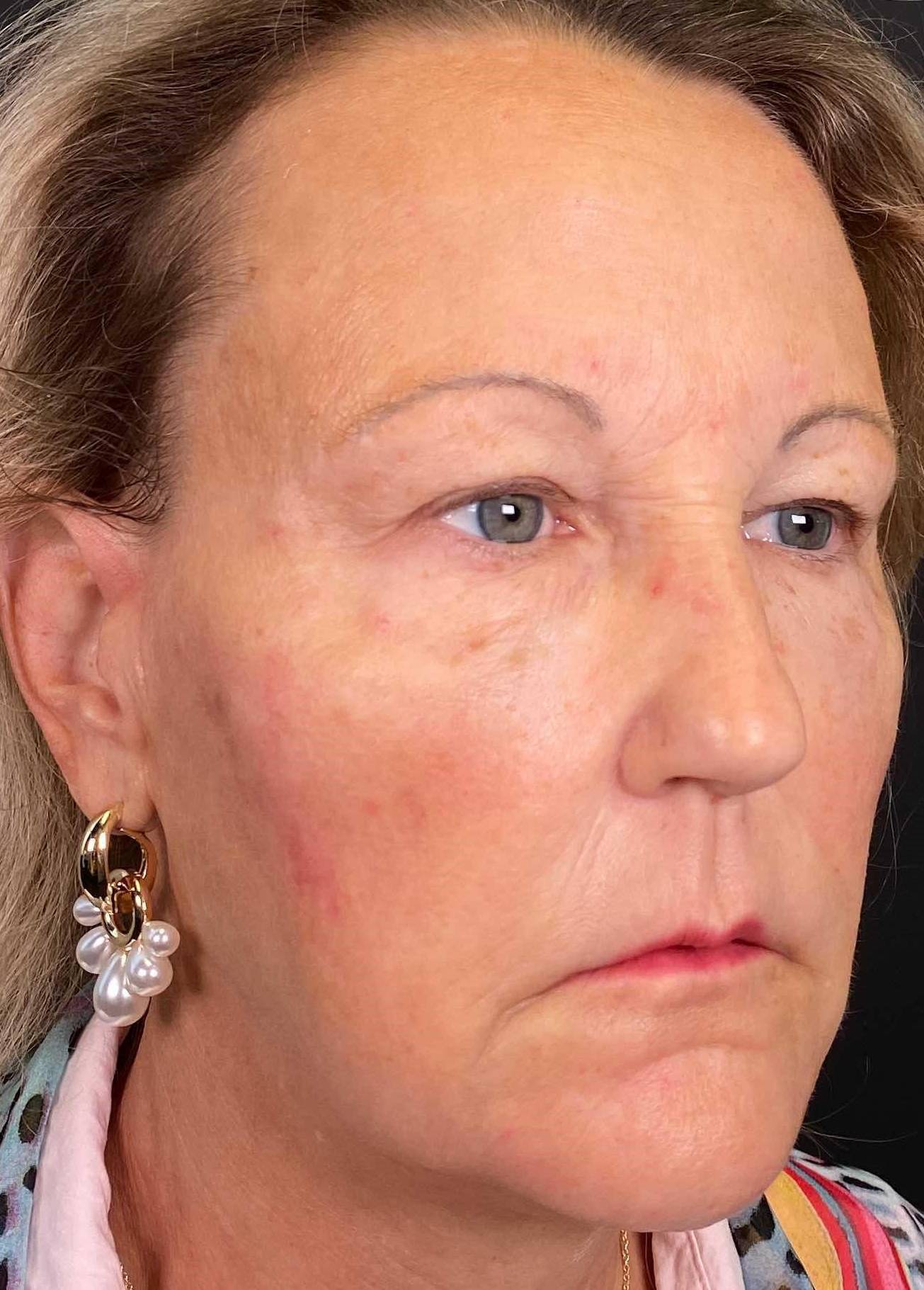 Voluma (8 Syringes) Case-17 After