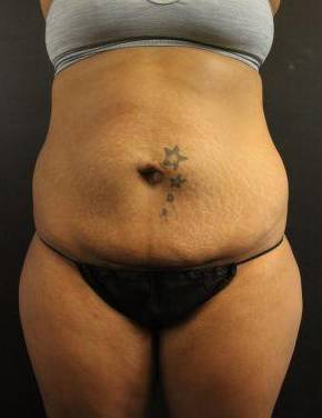 CoolSculpting<sup>®</sup> Before and After Case 1 Before