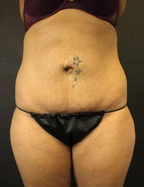 CoolSculpting<sup>®</sup> Before and After Case 1 After