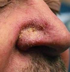 SRT-100 Radiation Before and After 9 Before