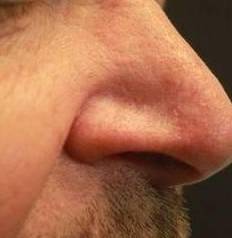 SRT-100 Radiation Before and After 9 After